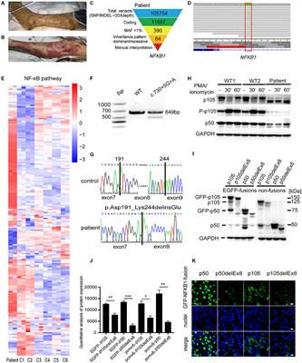 Case Report: A Novel Mutation in NFKB1 Associated With Pyoderma Gangrenosum